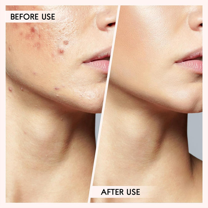 Blackhead & Pimple Extractor Kit-Nora Luxe